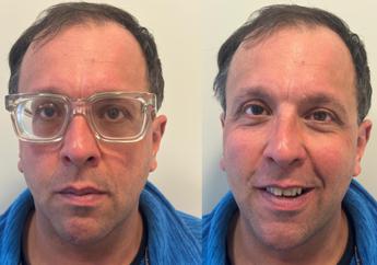 Lenti ICL: una soluzione efficace anche per miopie moderate