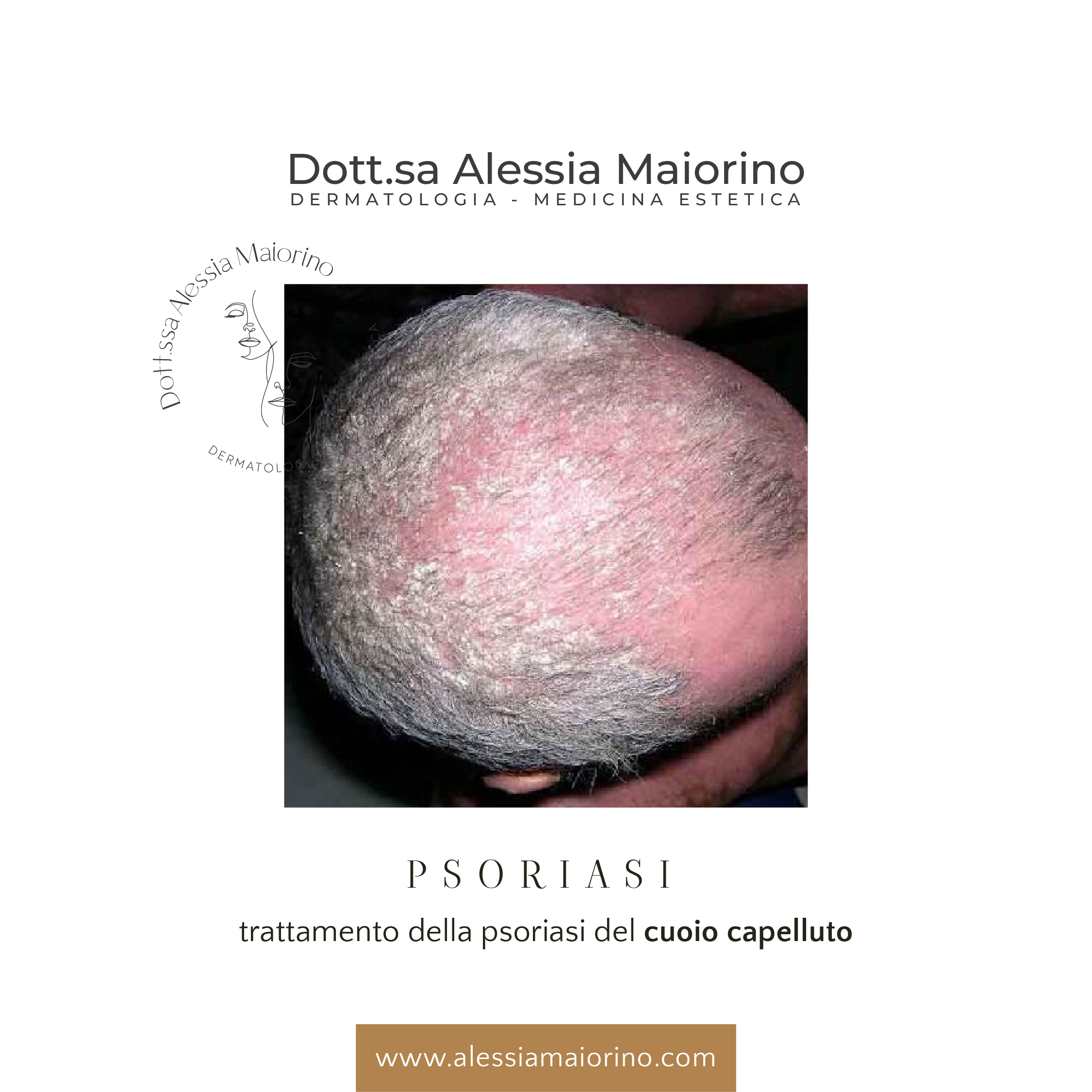 psoriasi cuoio capelluto