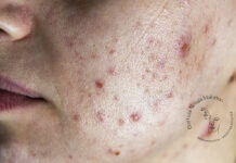 Acne in età adulta: quando la pelle cambia e la radiofrequenza ad aghi diventa un alleato prezioso acne in età adulta