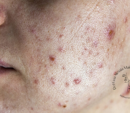 acne in età adulta