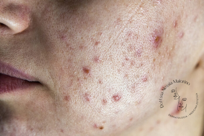 acne in età adulta