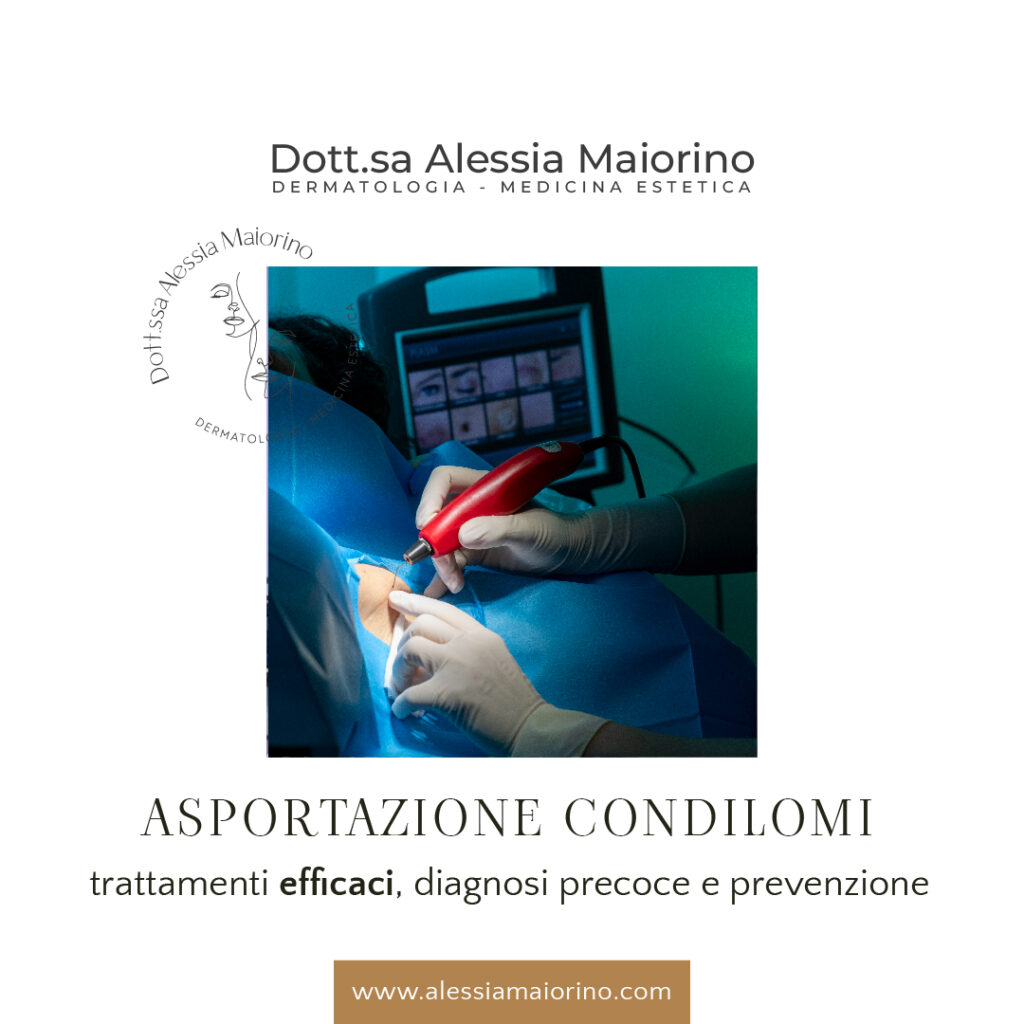 asportazione condilomi a Salerno