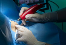 asportazione condilomi a salerno