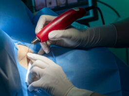 asportazione condilomi a salerno