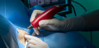 asportazione condilomi a salerno