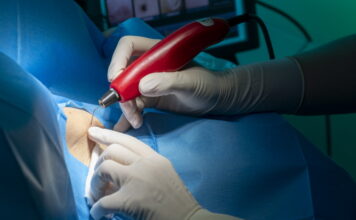 asportazione condilomi a salerno