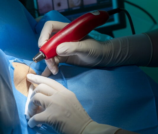 asportazione condilomi a salerno