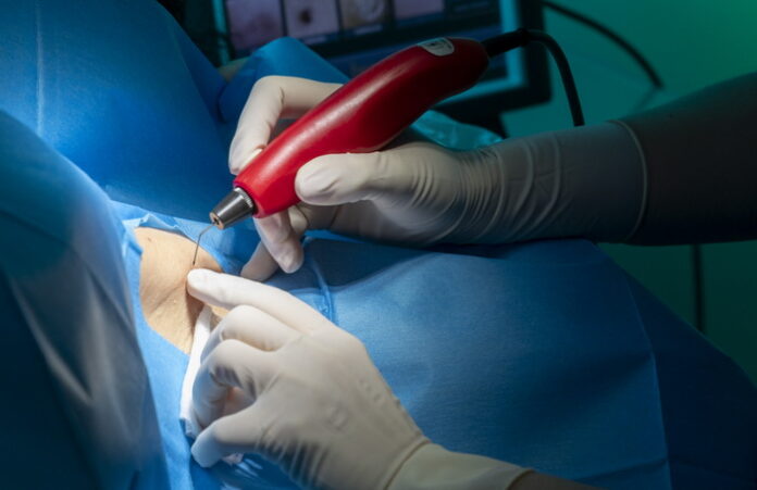 asportazione condilomi a salerno