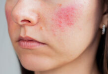 rosacea trattamento laser a salerno