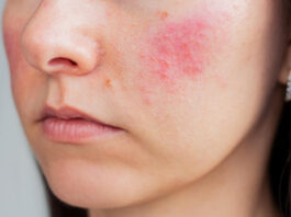 rosacea trattamento laser a salerno
