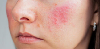 rosacea trattamento laser a salerno