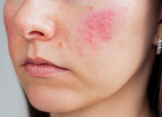 Rosacea e capillari visibili: “Il laser oggi permette di migliorare rossore e couperose in modo efficace”. L’intervista alla dermatologa Alessia Maiorino rosacea trattamento laser a salerno