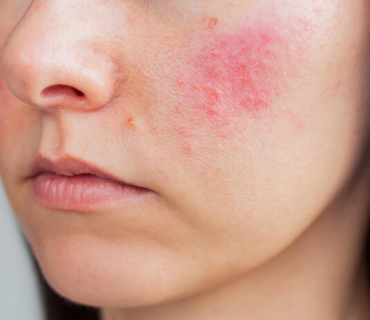 rosacea trattamento laser a salerno