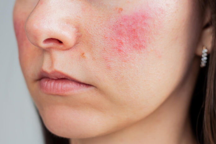 rosacea trattamento laser a salerno