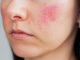 rosacea trattamento laser a salerno
