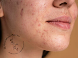 rimedi acne estate