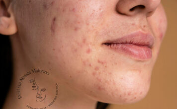 rimedi acne estate