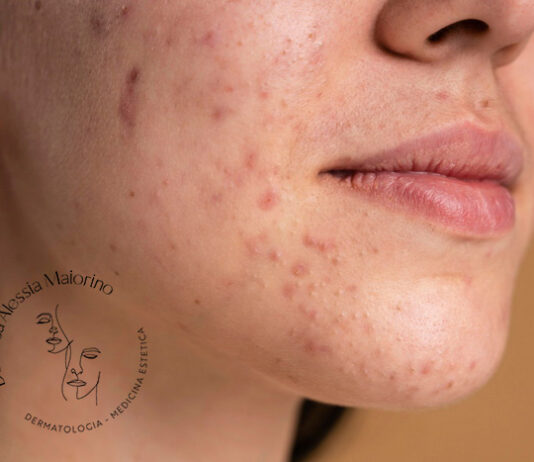 rimedi acne estate