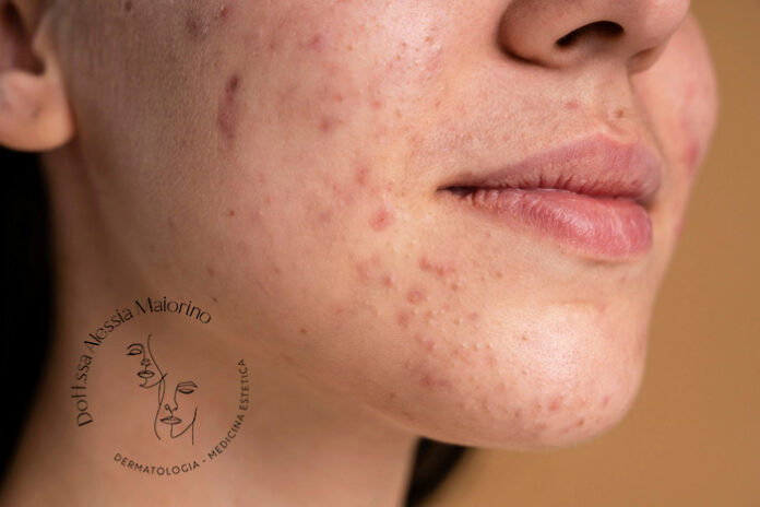 rimedi acne estate