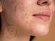 Acne estiva: come trattarla in modo efficace e sicuro. Intervista alla dermatologa Alessia Maiorino rimedi acne estate