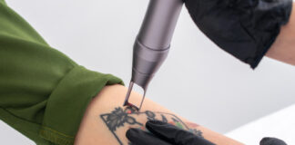 Dottoressa Alessia Maiorino trattamento laser per la rimozione dei tatuaggi a Salerno