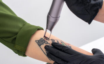 Rimozione dei tatuaggi con il laser: la dermatologa Alessia Maiorino spiega come funziona il trattamento Dottoressa Alessia Maiorino trattamento laser per la rimozione dei tatuaggi a Salerno