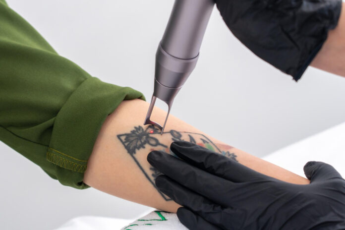 rimozione-tatuaggi (2) Dottoressa Alessia Maiorino trattamento laser per la rimozione dei tatuaggi a Salerno